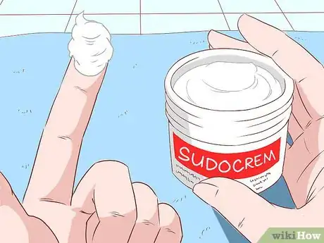 Imagen titulada Treat Jock Itch With Sudocrem Step 5