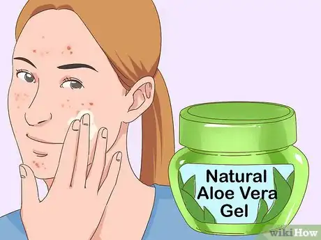 Imagen titulada Get Rid of Acne Fast Step 11