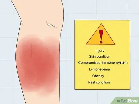 Imagen titulada Treat Cellulitis Step 1