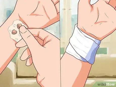 Imagen titulada Remove Warts Naturally Using Garlic Step 4