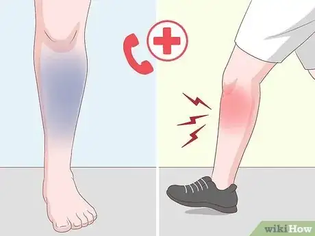 Imagen titulada Get Rid of Leg Pain Step 16