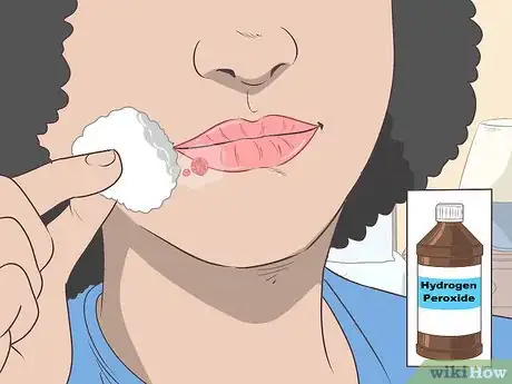 Imagen titulada Treat a Cold Sore or Fever Blisters Step 19