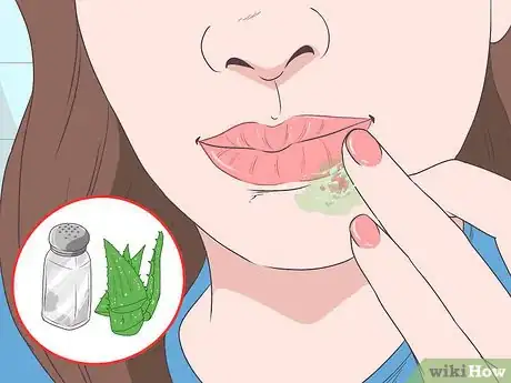 Imagen titulada Treat a Cold Sore or Fever Blisters Step 22