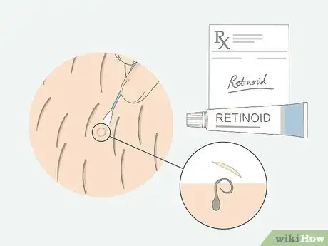 Imagen titulada Get Rid of Ingrown Pubic Hair Step 8