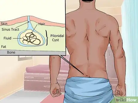 Imagen titulada Treat a Pilonidal Cyst Step 11