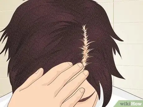 Imagen titulada Bumps on Scalp Step 3