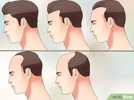 Imagen titulada Measure Hair Loss Step 1