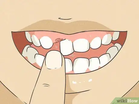 Imagen titulada Pull Out a Tooth Without Pain Step 3