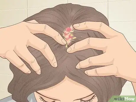 Imagen titulada Bumps on Scalp Step 16