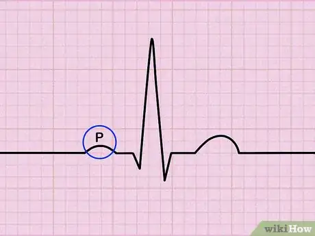 Imagen titulada Read an EKG Step 3