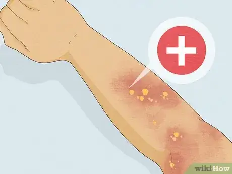 Imagen titulada Dry Up Poison Ivy Rash Step 9