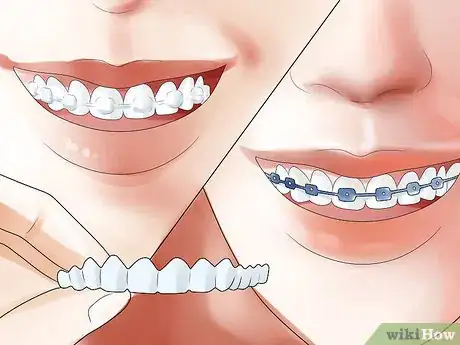 Imagen titulada Determine if You Need Braces Step 18