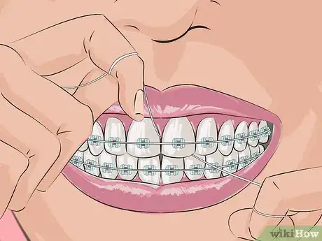 Imagen titulada Deal with Braces Step 2