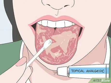 Imagen titulada Treat Geographic Tongue Step 2