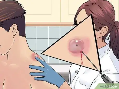 Imagen titulada Remove a Sebaceous Cyst Step 3