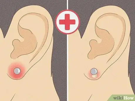 Imagen titulada Treat Infected Piercings Step 1