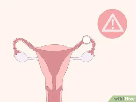 Imagen titulada Identify Abnormal Vaginal Spotting Between Periods Step 9