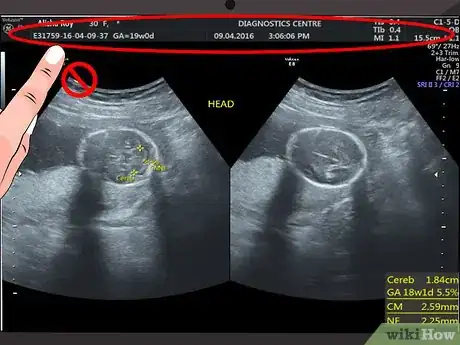 Imagen titulada Read an Ultrasound Picture Step 1