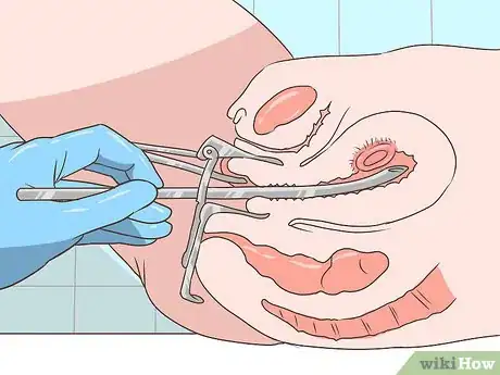 Imagen titulada Decide Whether or Not to Get an Abortion Step 5