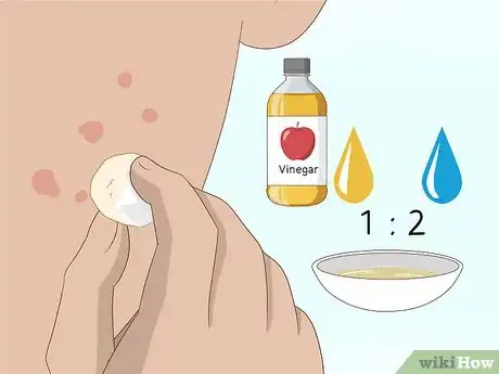 Imagen titulada Get Rid of Acne Scars Fast Step 17