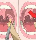 quitar piedrecillas de las amígdalas (tonsilolitos)