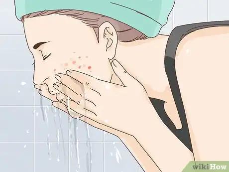 Imagen titulada Get Rid of a Popped Pimple Overnight Step 4