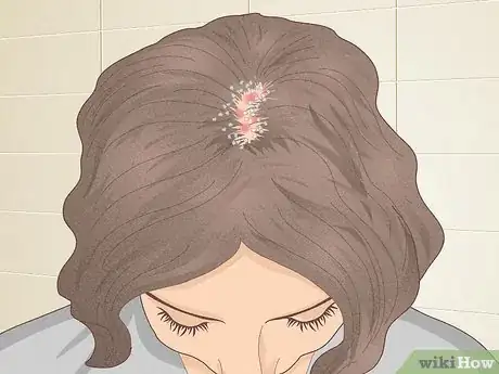 Imagen titulada Bumps on Scalp Step 2