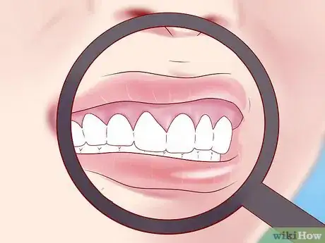 Imagen titulada Tell if You Have Mouth Cancer Step 1