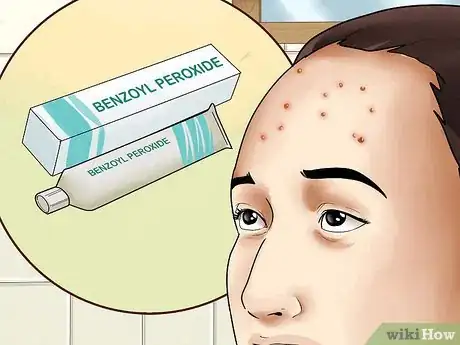 Imagen titulada Get Rid of Forehead Acne Step 1