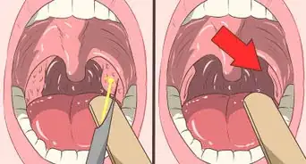 quitar piedrecillas de las amígdalas (tonsilolitos)