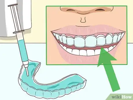 Imagen titulada Cope with Teeth Whitening Sensitivity Step 3