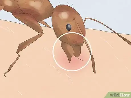 Imagen titulada Treat a Fire Ant Sting Step 8
