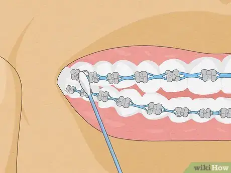 Imagen titulada Temporarily Fix a Loose Wire on Your Braces Step 3