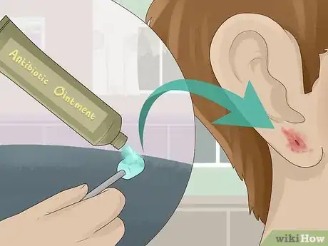 Imagen titulada Clean an Infected Ear Piercing Step 4