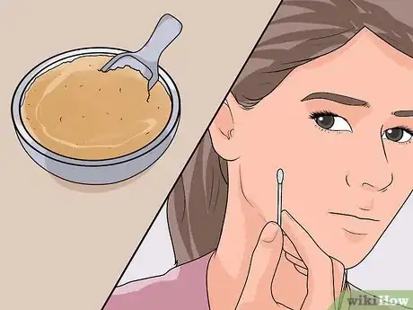 Imagen titulada Get Rid of Acne With Home Remedies Step 14