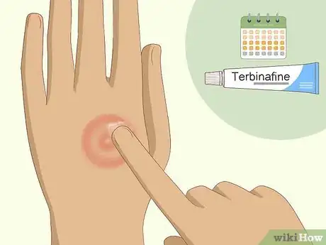 Imagen titulada Get Rid of Ringworm Naturally Step 4