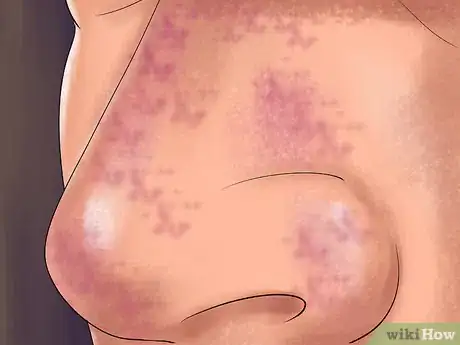 Imagen titulada Treat a Yeast Infection on Your Skin Step 3