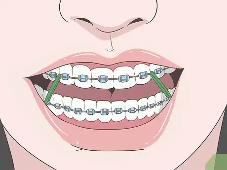 Imagen titulada Eat Food With New or Tightened Braces Step 12