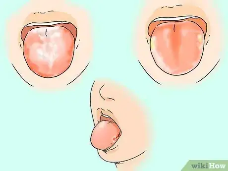 Imagen titulada Get Rid of White Tongue Step 13