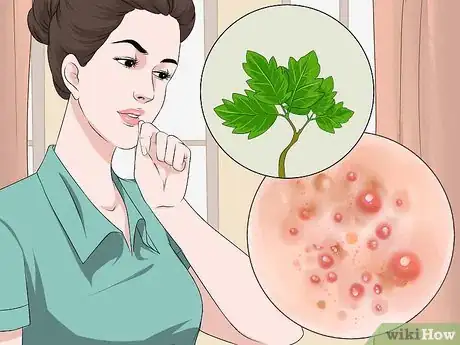 Imagen titulada Get Rid of Poison Oak Rash Step 13