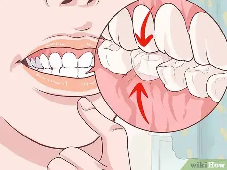 Imagen titulada Fix a Lost Dental Crown Step 11