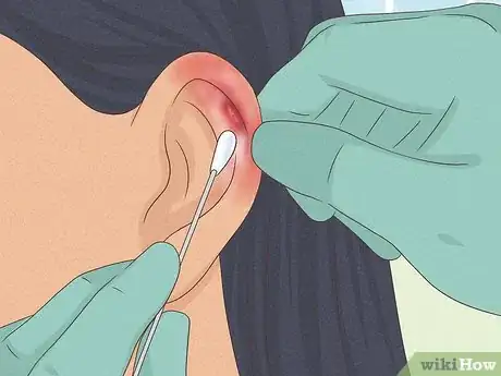Imagen titulada Heal Cartilage Piercing Bumps Step 5