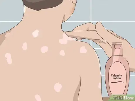 Imagen titulada Treat Chickenpox at Home Step 2