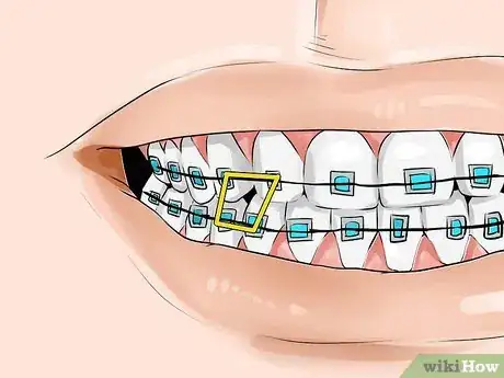 Imagen titulada Connect a Rubber Band to Your Braces Step 6