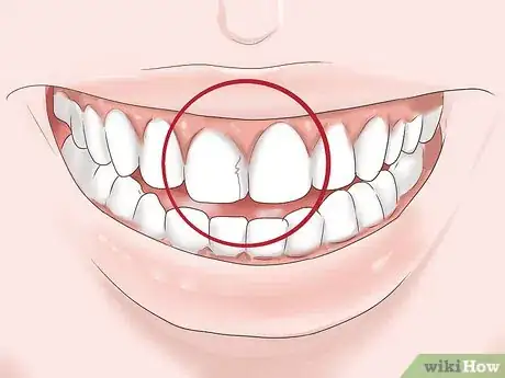 Imagen titulada Know if Your Dental Fillings Need Replacing Step 8