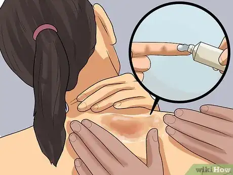 Imagen titulada Get Rid of Heat Rash Step 10