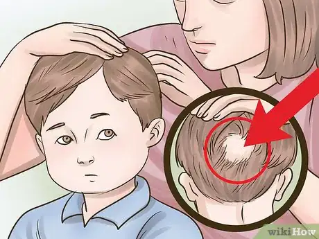 Imagen titulada Stop Hair Loss in Children Step 1