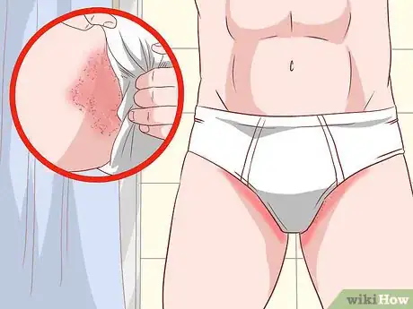 Imagen titulada Prevent Skin Fungus Step 9