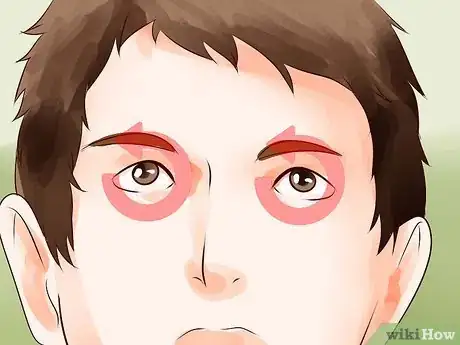 Imagen titulada Soothe Sore Eyes Step 5