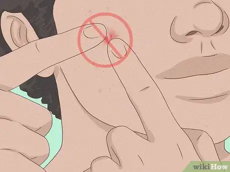 Imagen titulada Get Rid of a Zit Overnight Step 16